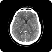 33 Brain-CT-AI-Scan
