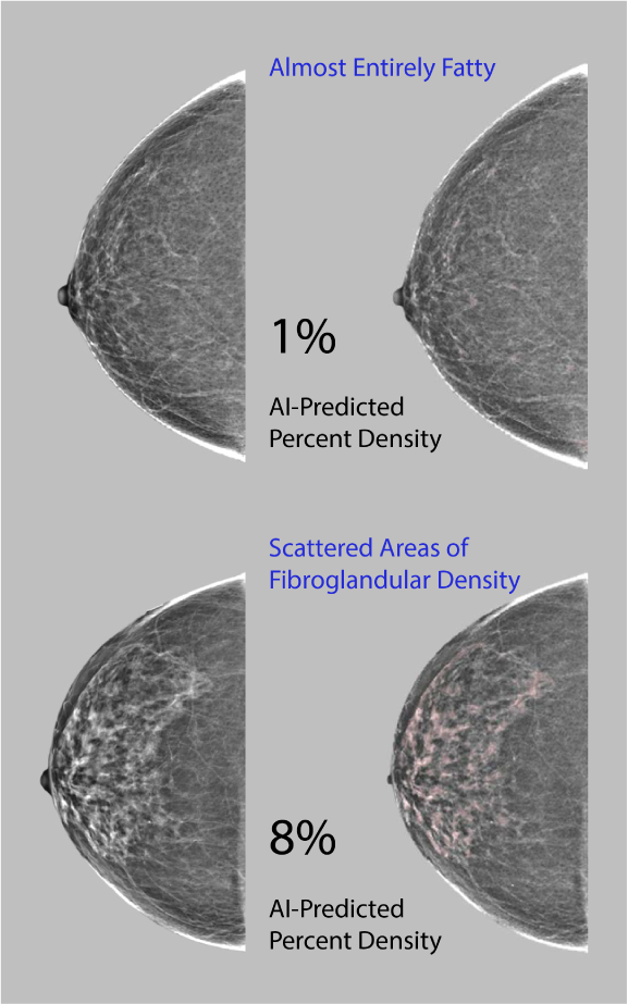 AI Provides Accurate Breast Density Classification