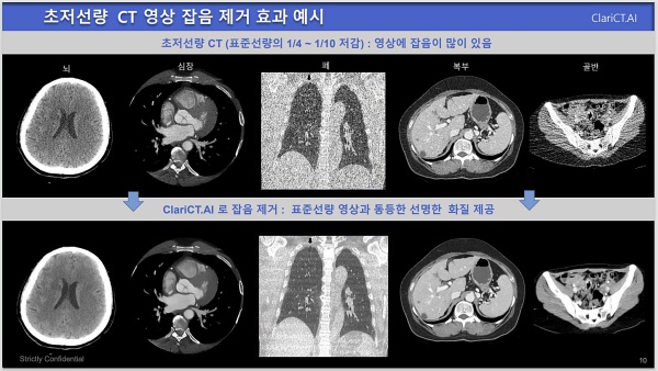 Significantly Reducing CT Radiation Dose With Ultra Low Dose Noise   Image 1 